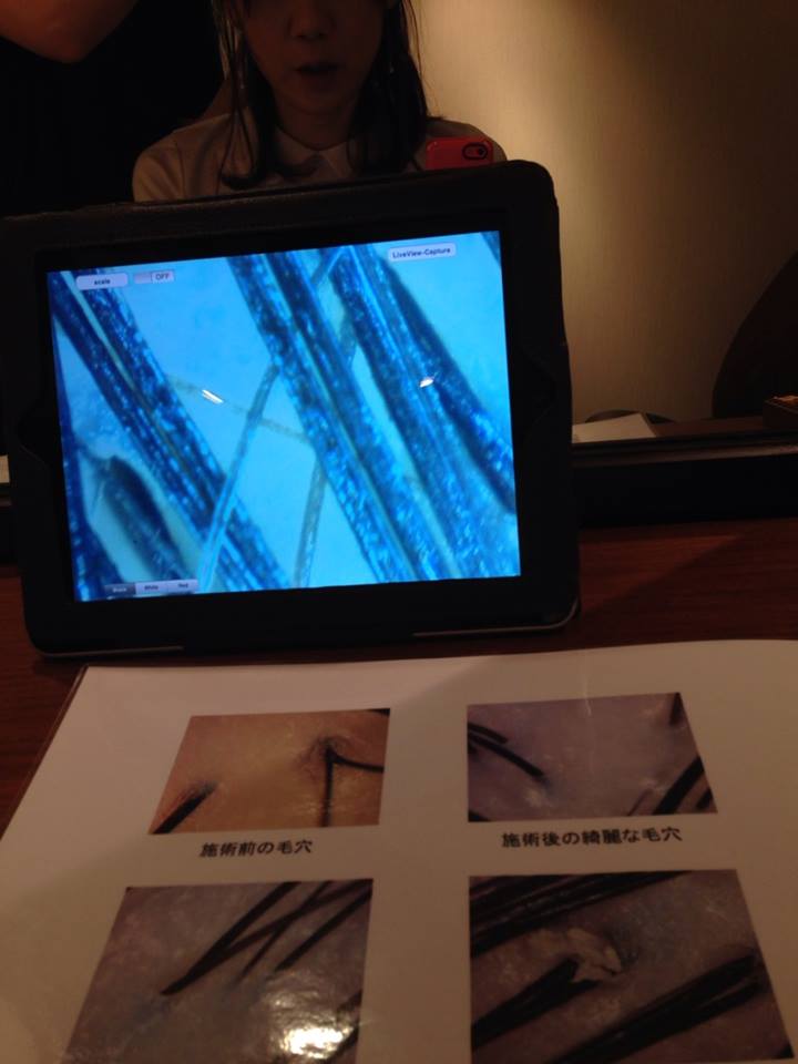 ベルシュヴー,抜け毛,頭皮