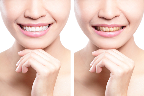 ホワイトニング