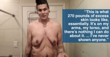 伸びてしまった皮膚 伸びてしまった皮膚