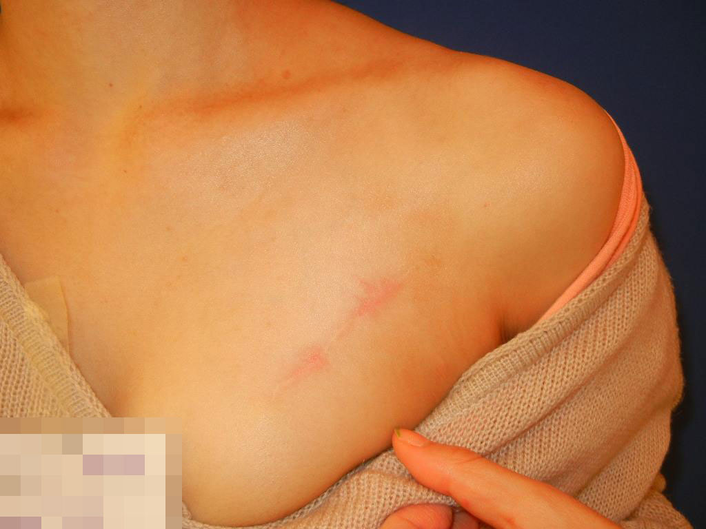 切除縫合術After