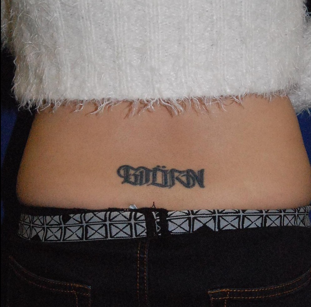 切除縫合術（腰）Before