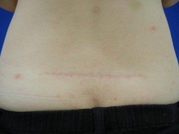 切除縫合術(腰)After 切除縫合術(腰)After
