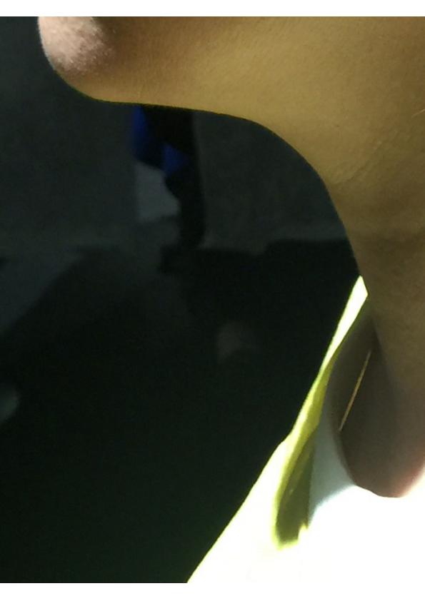 あごのたるみafter