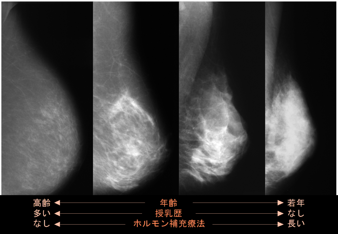 加齢による乳腺の変化 加齢による乳腺の変化
