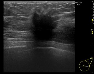 超音波検診（エコー）の画像