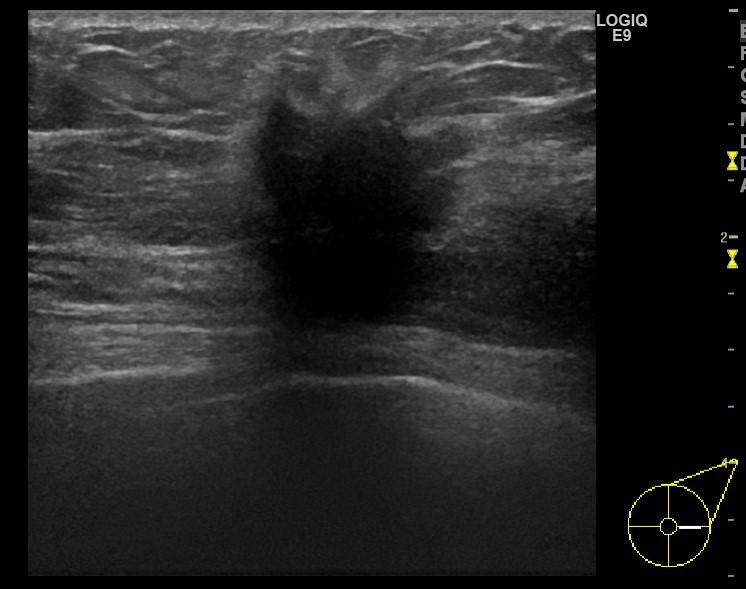 超音波検診（エコー）の画像