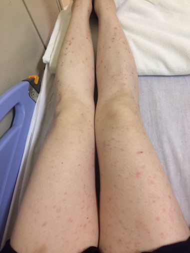 足全体に広がる湿疹 足全体に広がる湿疹