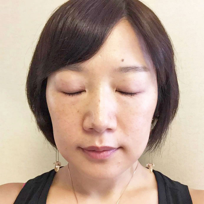 施術前の筆者です