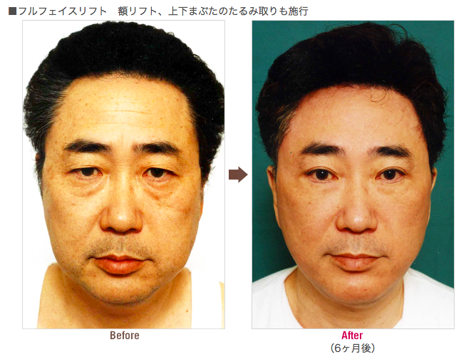 高須院長もフェイスリフト