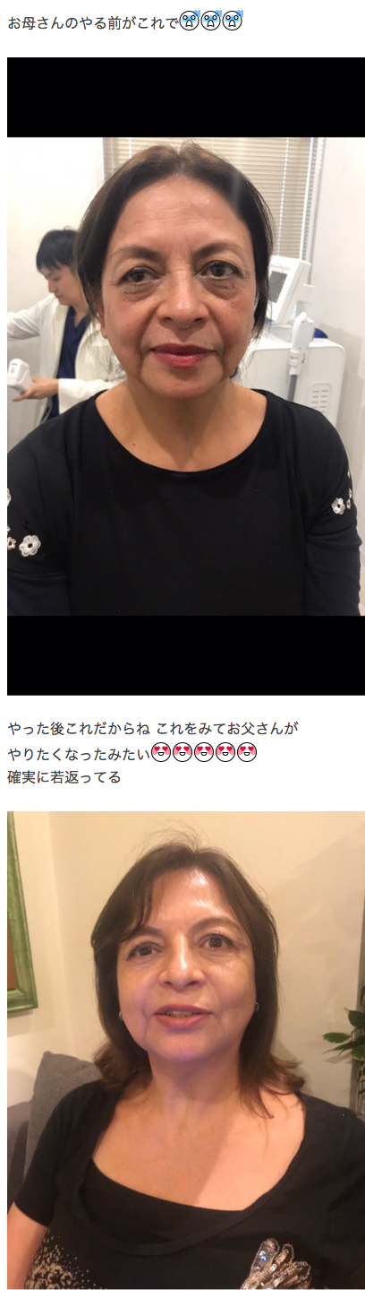 アレクサンダー公式ブログ06月10日投稿「アレクパパ 整形をする‼️の巻だ I 」より