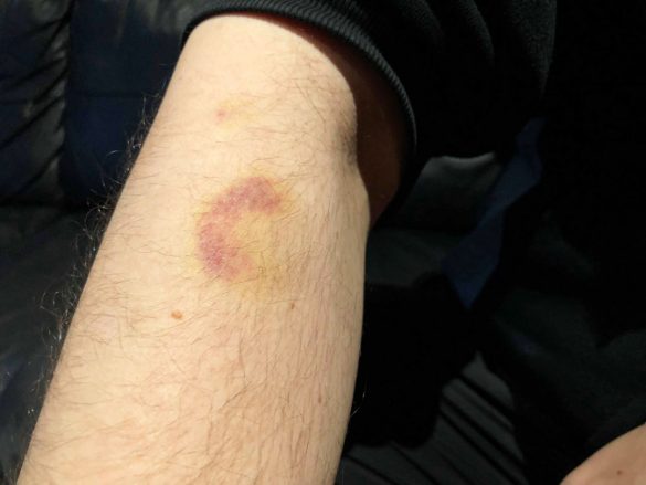 痛々しく残るアザ