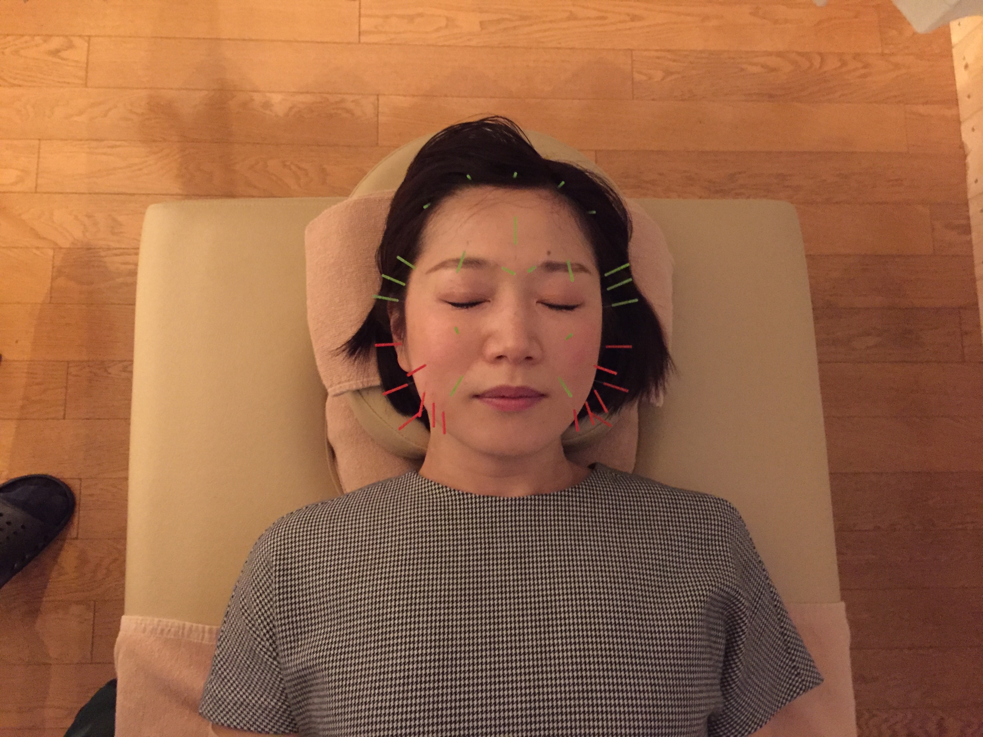 美容鍼（刺し終わり）