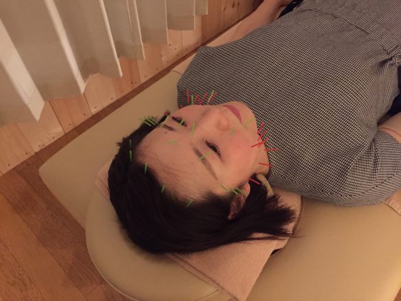 美容鍼（刺し終わり）