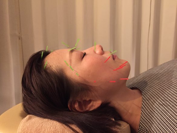 美容鍼（刺し終わり）