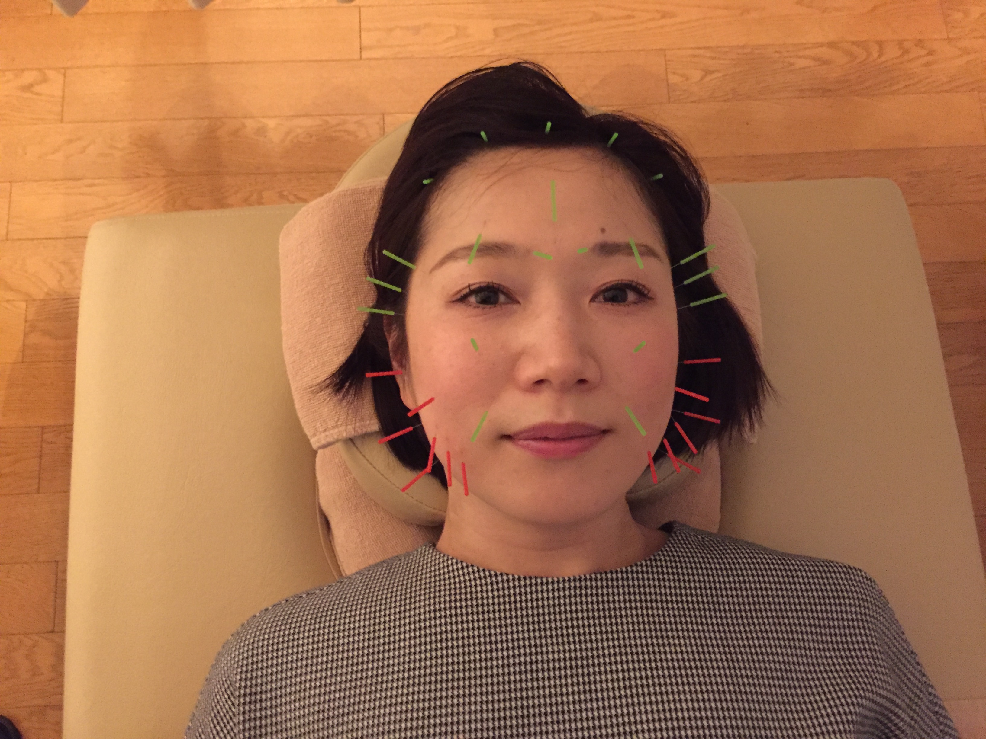 美容鍼（刺し終わり）