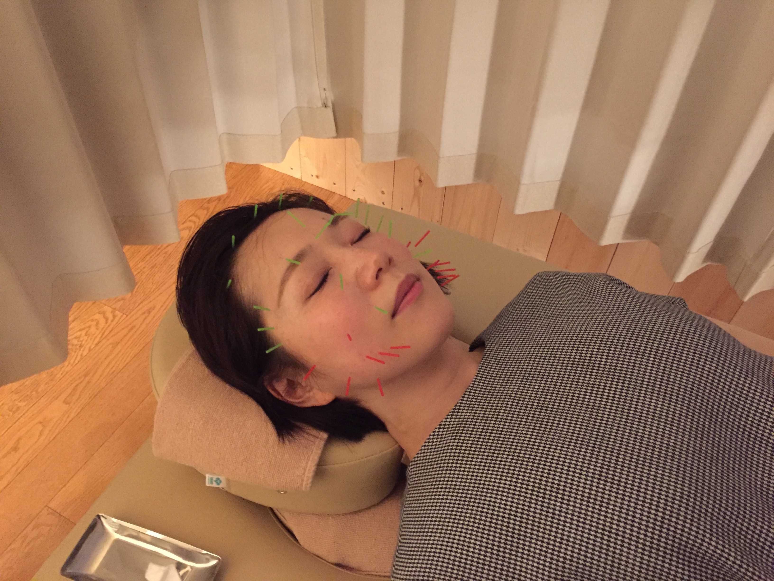 美容鍼（刺し終わり）