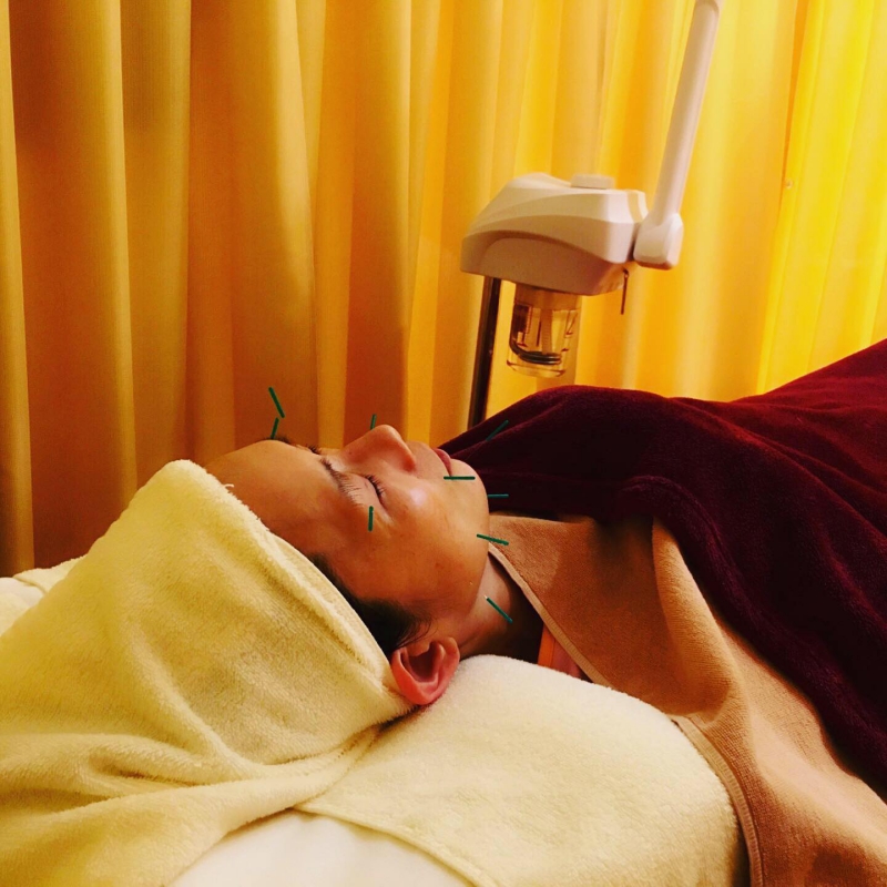 最新美容鍼レポート