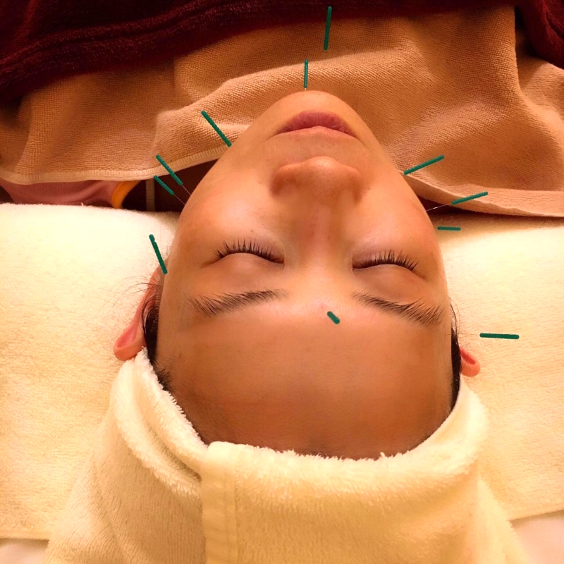 最新美容鍼レポート