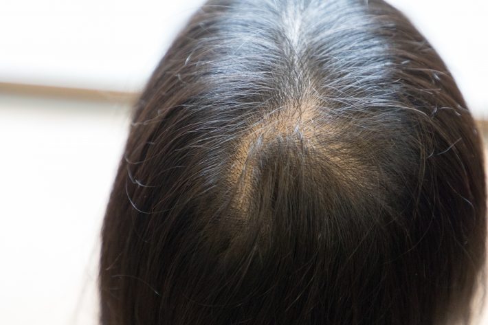 薄毛になる原因