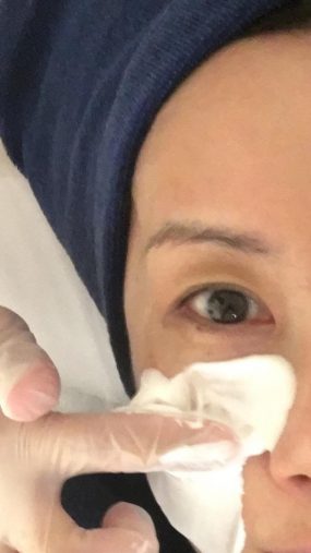 麻酔クリームを顔全体に塗る