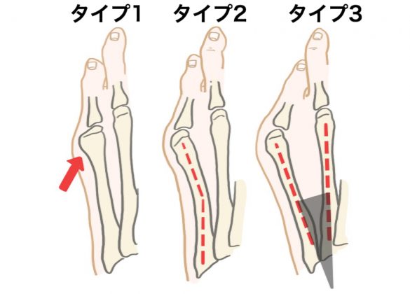 外販小趾の原因3タイプ