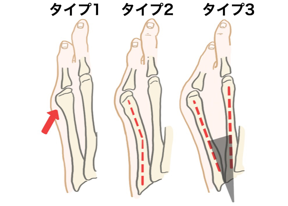 外販小趾の原因3タイプ