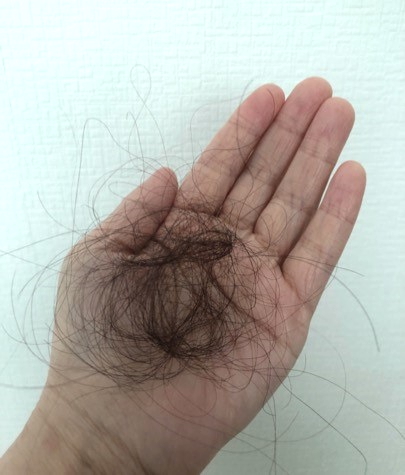 産後10ケ月、E美さんのごっそり抜け毛