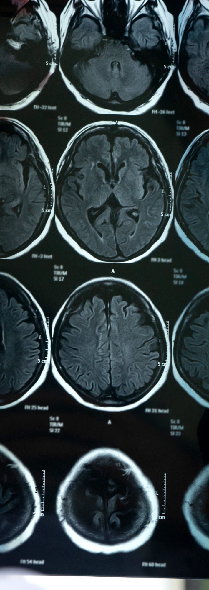 脳梗塞の原因が判明、告げられた病名は…