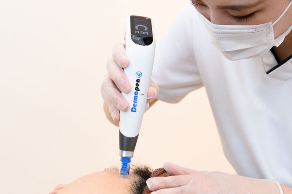 ダーマペンの口は、細い針の剣山みたいになっている