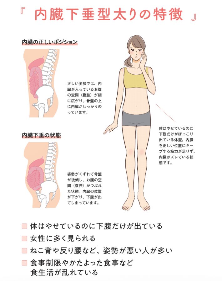 ぽっこり下腹の正体「内臓下垂」とは
