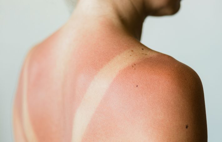 日焼けはやけど、あまく見てはダメ