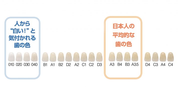 ホワイトニングで歯を白くできる限界