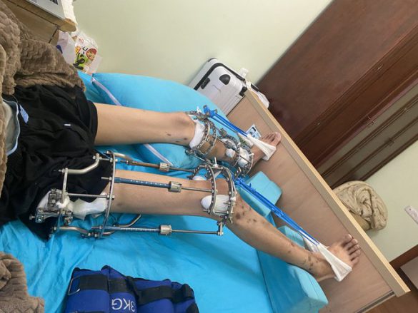 ゆうり　骨延長