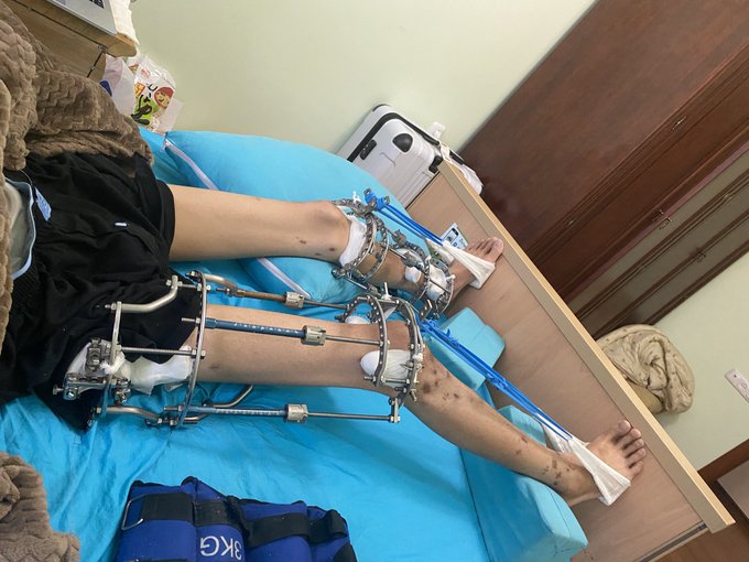 ゆうり　骨延長