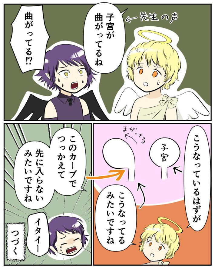 ミレーナ　装着レポ