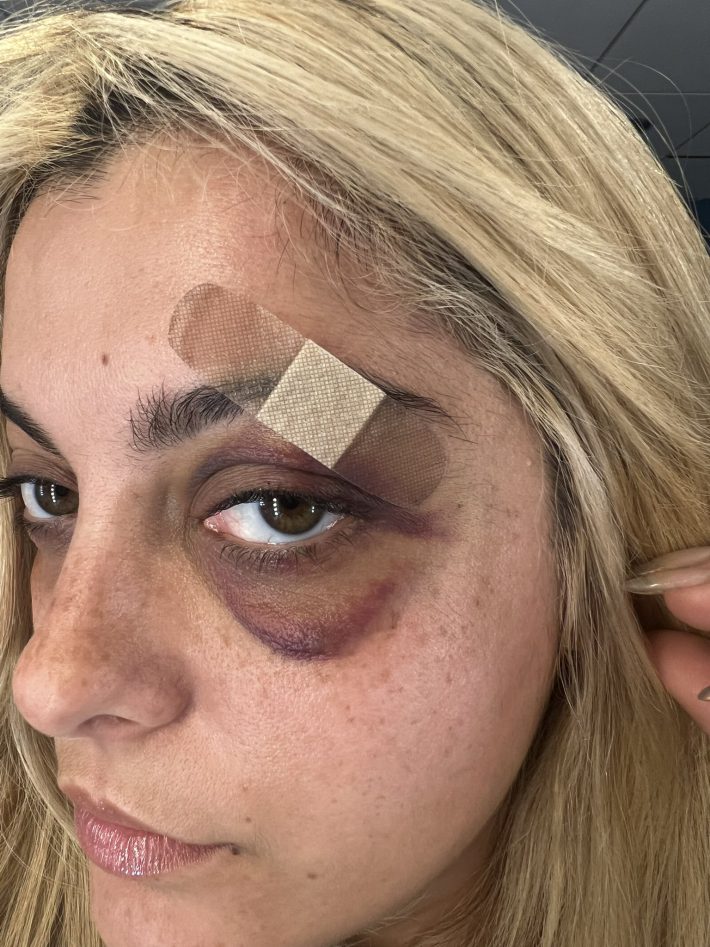 Twitterに投稿された目元のアザの写真