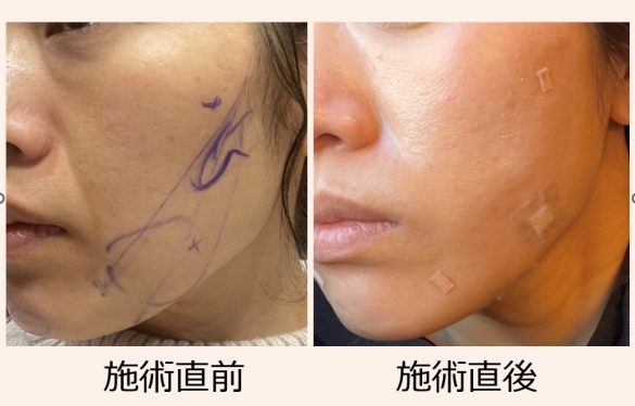 「糸リフト」施術の直前直後