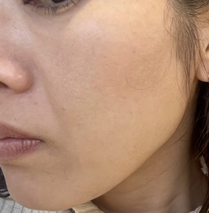 「糸リフト」施術日から1ヶ月半後の筆者