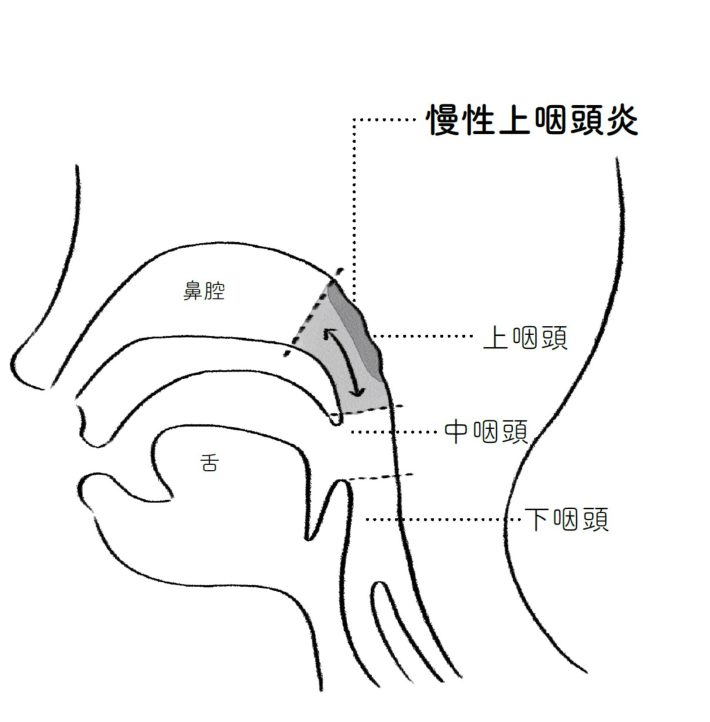 『その不調の原因は慢性上咽頭炎にあった』