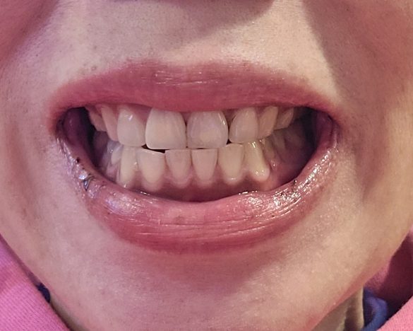 飲み物で口内を潤さずに撮影した口周りの写真。無修正で失礼します