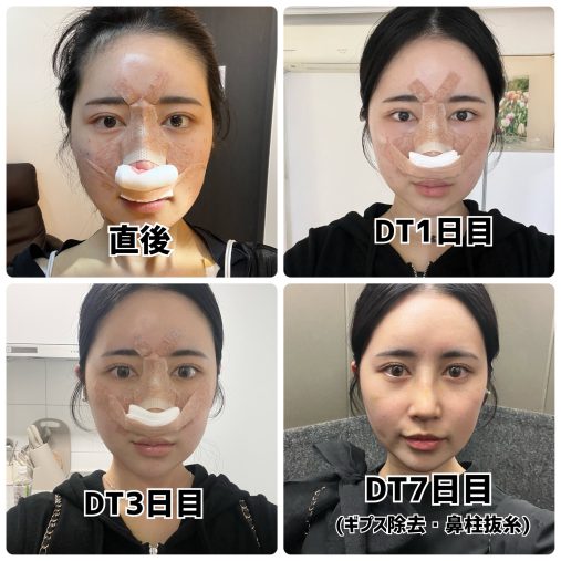 6月には鼻整形をし、その過程を紹介
