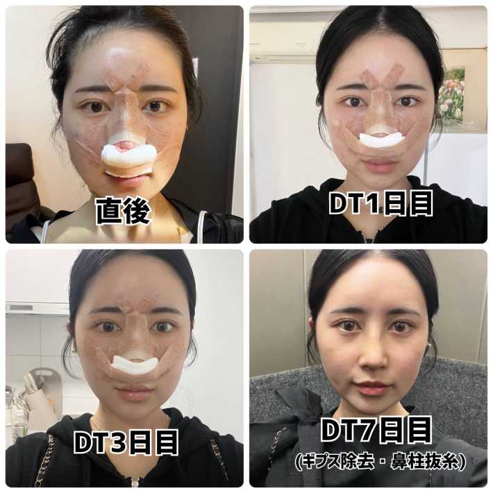 6月には鼻整形をし、その過程を紹介