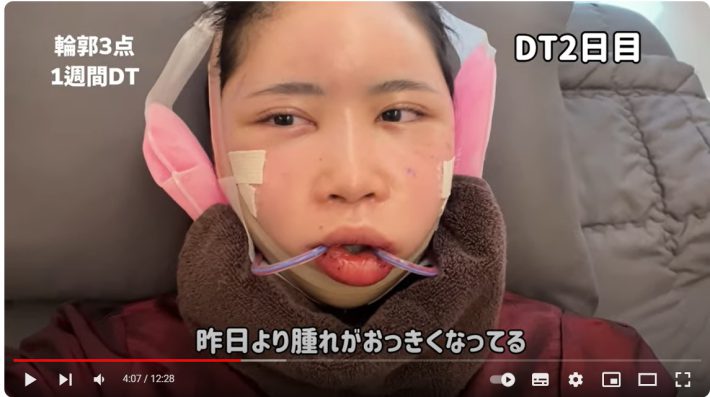 ３ケ月前には輪郭３点を整形