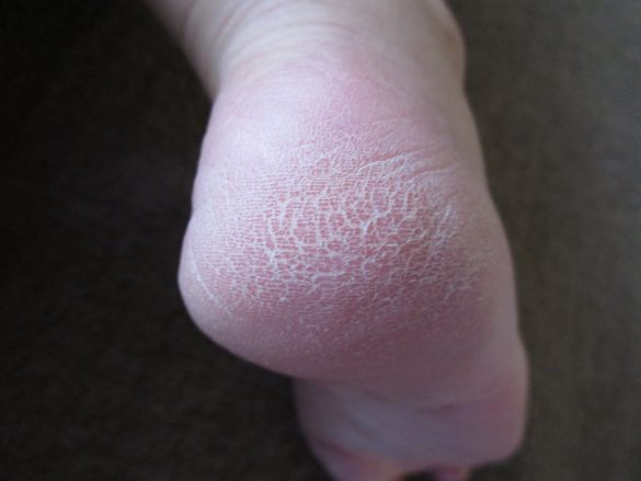 かかと ひび割れ